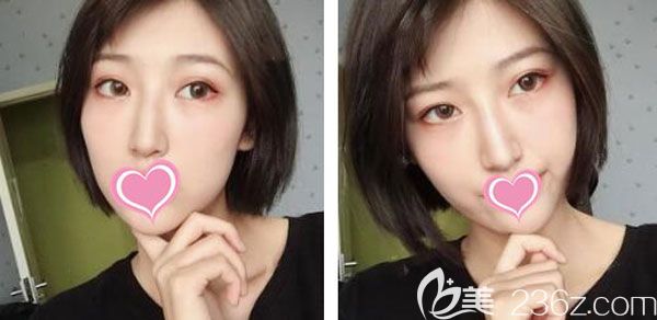 双眼皮术后第3天眼睛肿胀比较严重 双眼皮术后第3天眼睛肿胀比较严重