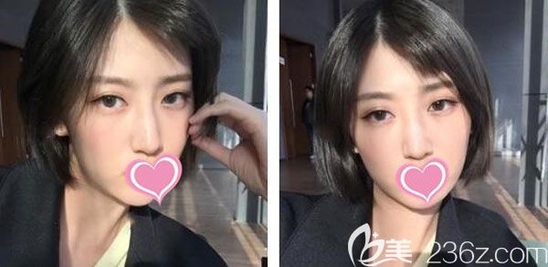 双眼埋线恢复第7天图片眼部的肿胀基本已经消退 双眼埋线恢复第7天图片眼部的肿胀基本已经消退