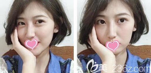 埋线双眼皮10天恢复图眼睛又大又有神 埋线双眼皮10天恢复图眼睛又大又有神