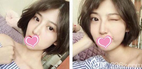 埋线双眼皮一个月的恢复效果自然有灵气 埋线双眼皮一个月的恢复效果自然有灵气