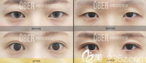 韩国玉芭双眼皮手术案例