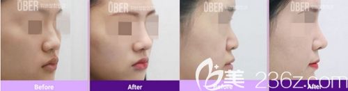 韩国玉芭隆鼻修复案例 韩国玉芭隆鼻修复案例