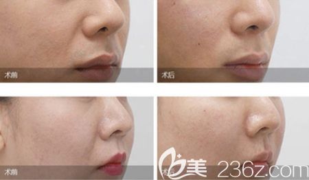 韩国玉芭埋线提升案例 韩国玉芭埋线提升案例