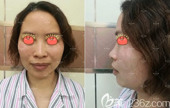 金华瑞丽做假体隆鼻手术前 金华瑞丽做假体隆鼻手术前