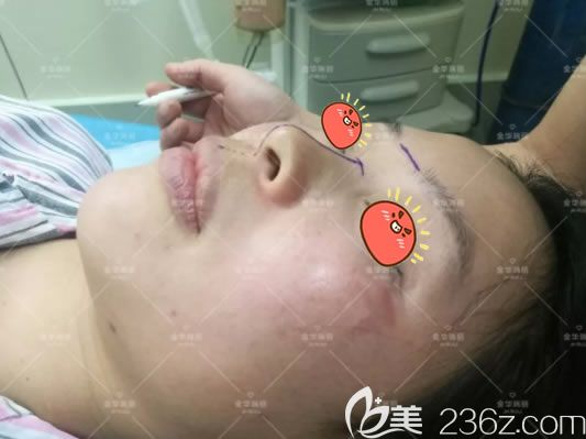 金华瑞丽刘政设计隆鼻方案 金华瑞丽刘政设计隆鼻方案