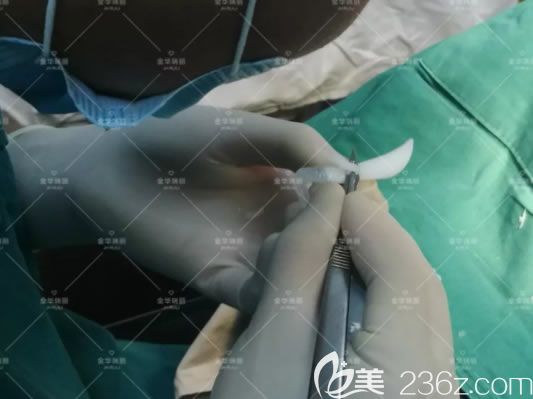 金华瑞丽刘政假体隆鼻手术过程 金华瑞丽刘政假体隆鼻手术过程