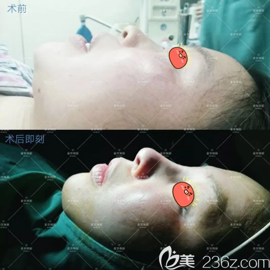 金华瑞丽假体隆鼻案例即刻效果 金华瑞丽假体隆鼻案例即刻效果