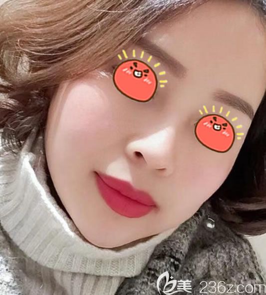 金华瑞丽刘政假体隆鼻案例 金华瑞丽刘政假体隆鼻案例