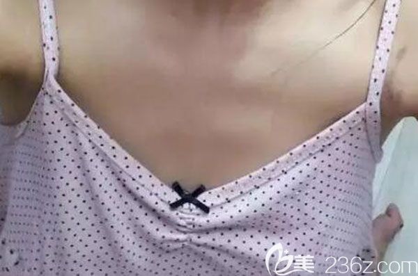 在昆明韩辰整形隆胸手术前 在昆明韩辰整形隆胸手术前