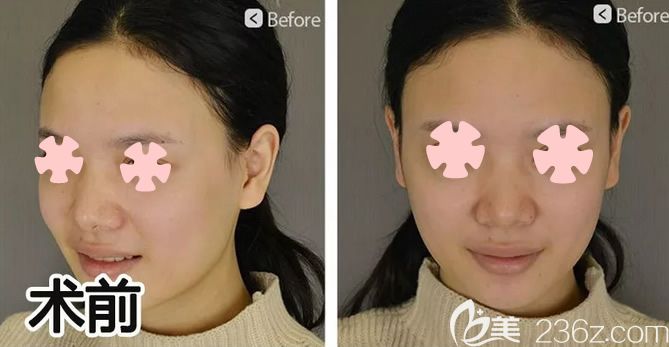 我在柳州华美做全脸自体脂肪填充前的照片 我在柳州华美做全脸自体脂肪填充前的照片