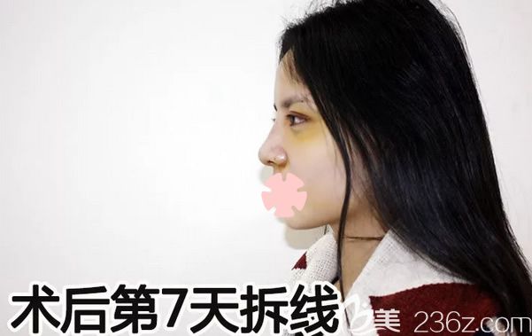 我在柳州华美做鼻综合和面部自体脂肪填充术后第7天 我在柳州华美做鼻综合和面部自体脂肪填充术后第7天