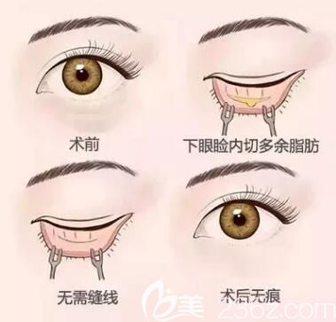 常州曙光韩式内吸去眼袋技术
