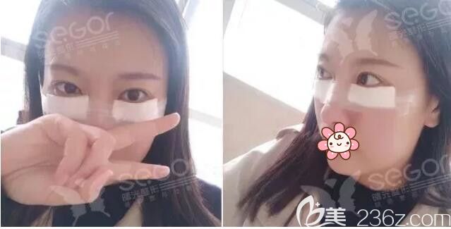 到常州曙光刚做完韩式内吸去眼袋