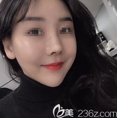 韩国玉芭做了隆鼻修复手术后7天