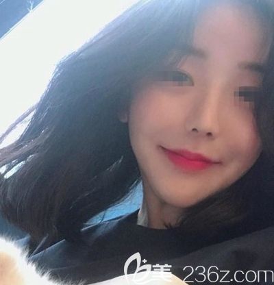 韩国玉芭做了隆鼻修复手术后2周