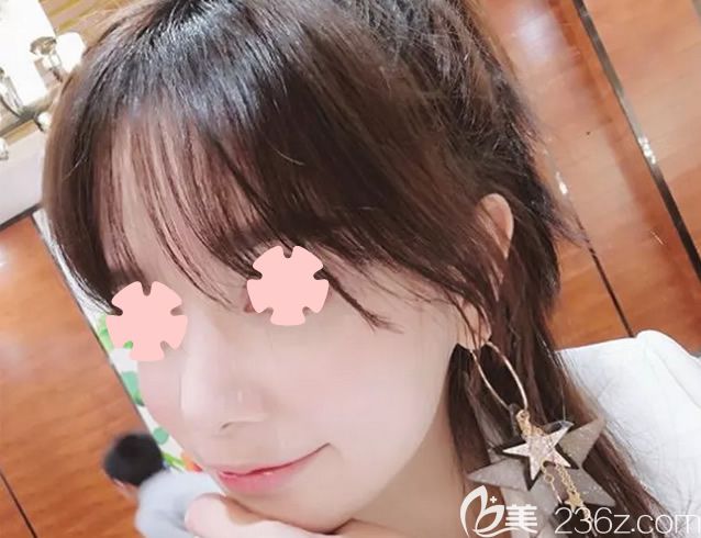 我在柳州华美做隆鼻和面部填充第30天 我在柳州华美做隆鼻和面部填充第30天