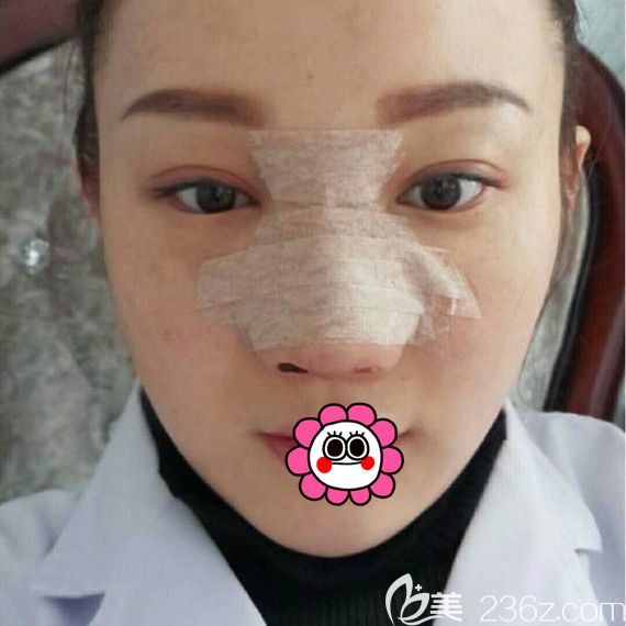 佳木斯韩艺来找李明贤做的鼻综合3天