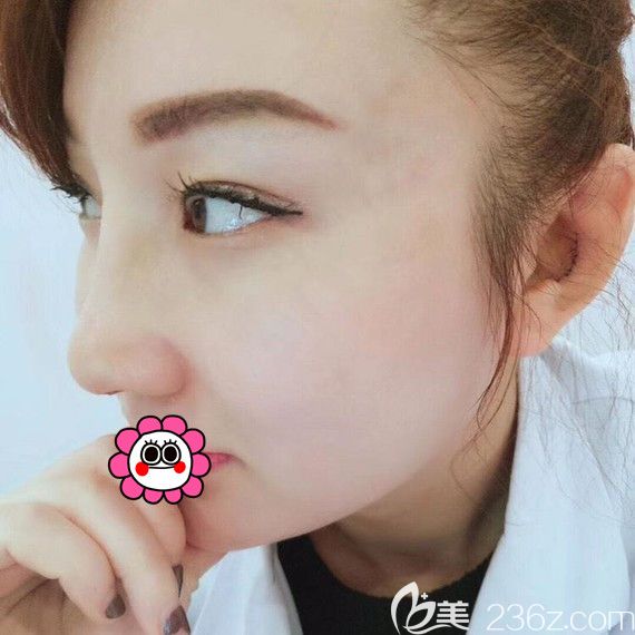 佳木斯韩艺来耳软骨隆鼻术后7天