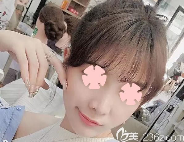 直播我在柳州华美整形做鼻综合隆鼻+全面部自体脂肪填充术后100天恢复过程