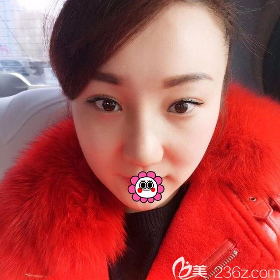 李明贤耳软骨隆鼻恢复1个月