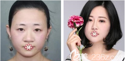 刘永涛双眼皮+隆鼻案例 刘永涛双眼皮+隆鼻案例