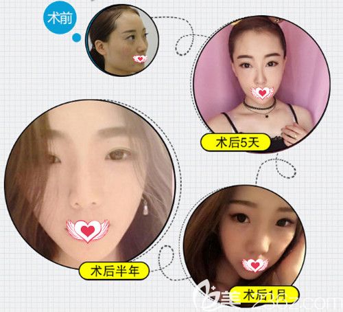 石家庄天宏整形医院注射瘦脸除皱瘦脸案例 石家庄天宏整形医院注射瘦脸除皱瘦脸案例