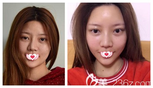 天宏整形做射频除皱案例 天宏整形做射频除皱案例