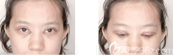 韩国爱慕双眼皮+开内眼角术后第1天效果 韩国爱慕双眼皮+开内眼角术后第1天效果