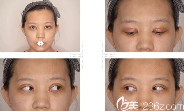 韩国爱慕全切双眼皮+开内眼角效果怎么样?真人案例供参考 韩国爱慕全切双眼皮+开内眼角效果怎么样?真人案例供参考
