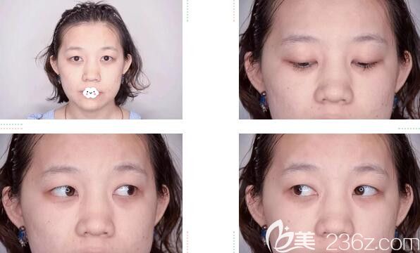 韩国爱慕整形双眼皮+开内眼角案例 韩国爱慕整形双眼皮+开内眼角案例