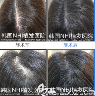 韩国头顶加密种植头发案例效果对比图