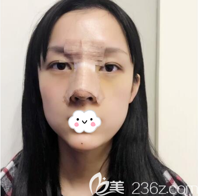 成都西区医院车红昌隆鼻术后即刻照片 成都西区医院车红昌隆鼻术后即刻照片