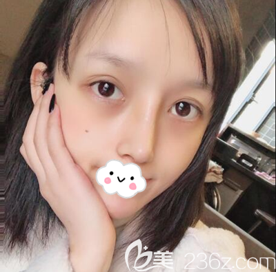 车红昌肋软骨鼻综合拆线后效果 车红昌肋软骨鼻综合拆线后效果