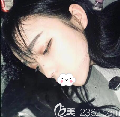 肋软骨隆鼻术后半个月恢复照片 肋软骨隆鼻术后半个月恢复照片