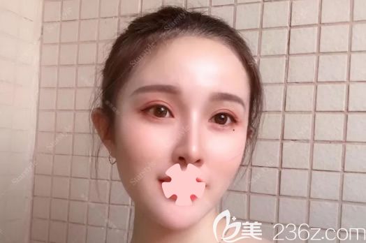  看了妹子在桂林星范整形割全切双眼皮+开眼角前后对比照片,你不心动吗？