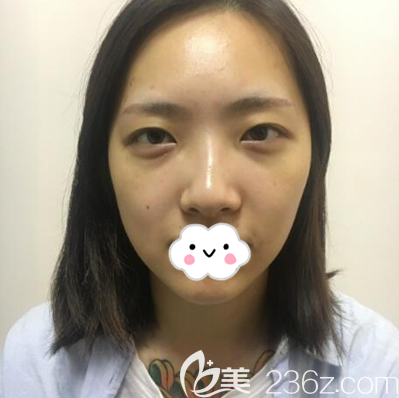 双眼皮开眼角术前照片 双眼皮开眼角术前照片