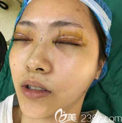 邓东伟眼综合手术术前设计 邓东伟眼综合手术术前设计