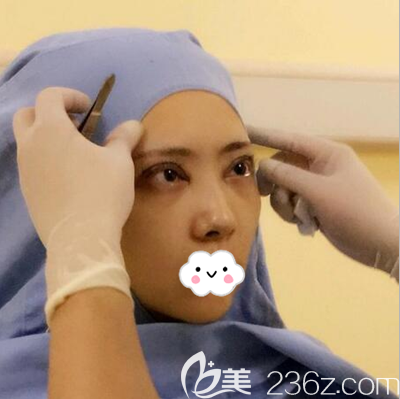 成都西区医院邓东伟术后调整双眼皮形状 成都西区医院邓东伟术后调整双眼皮形状