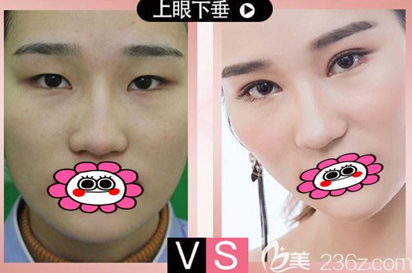 衡阳那个做双眼皮好？看衡阳曹家整形双眼皮案例