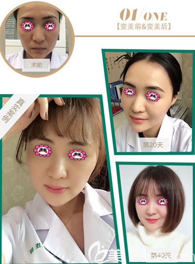 衡阳曹家医疗整形俞胜英自体脂肪面部填充前后对比图