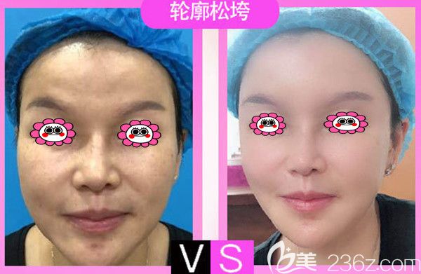 衡阳曹家罗碧强医生面部年轻化前后变化图