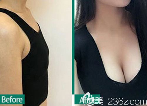 衡阳曹家整形医院曹新成隆胸案例