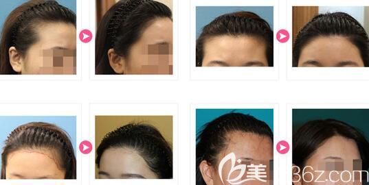 韩国JP女性发际线种植案例