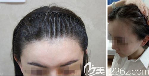 天生头顶头发稀少 分享我选择韩国JP毛发移植中心的无剃头发际线种植半年恢复效果