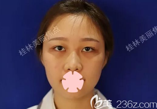 我在桂林美丽焦点做鼻综合隆鼻术前照 我在桂林美丽焦点做鼻综合隆鼻术前照