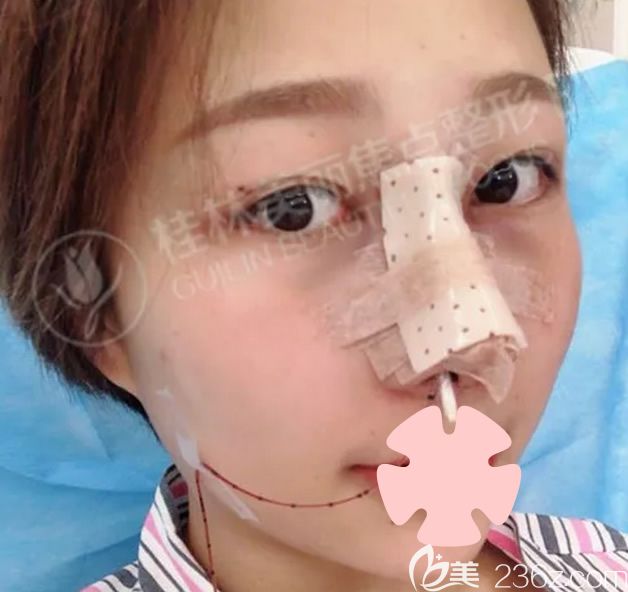我在桂林美丽焦点做鼻综合隆鼻术后当天 我在桂林美丽焦点做鼻综合隆鼻术后当天