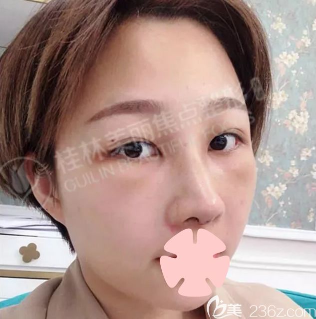 我在桂林美丽焦点做焦式隆鼻术后第3天