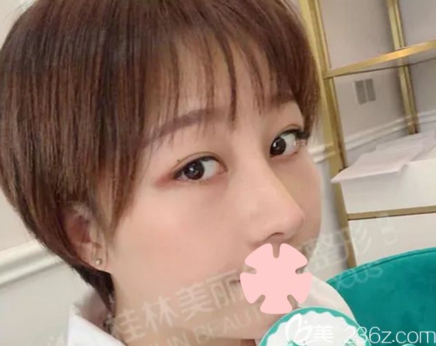 我在桂林美丽焦点做鼻综合术后第7天 我在桂林美丽焦点做鼻综合术后第7天