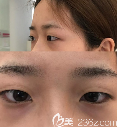 做帕克双眼皮术前眼部情况 做帕克双眼皮术前眼部情况