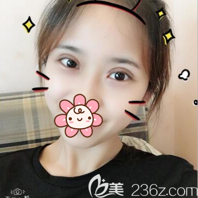 切开双眼皮术后一个月恢复效果 切开双眼皮术后一个月恢复效果